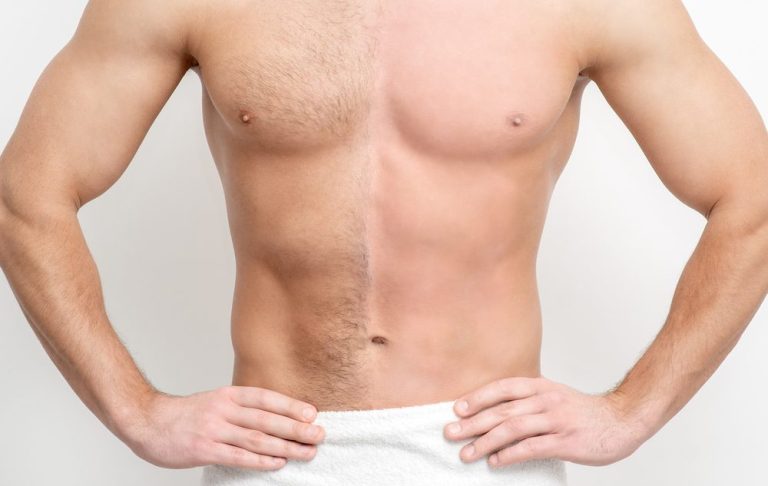 Elektroepilation des Oberkörpers Ein nackter Oberkörper eines Mannes mit sichtbar muskulösem Bauch und einer Narbe in der Mitte.