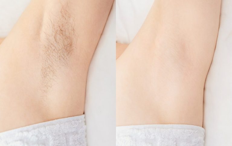 Elektroepilation der Achseln Unbehaarte und behaarte Achseln nebeneinander verglichen.